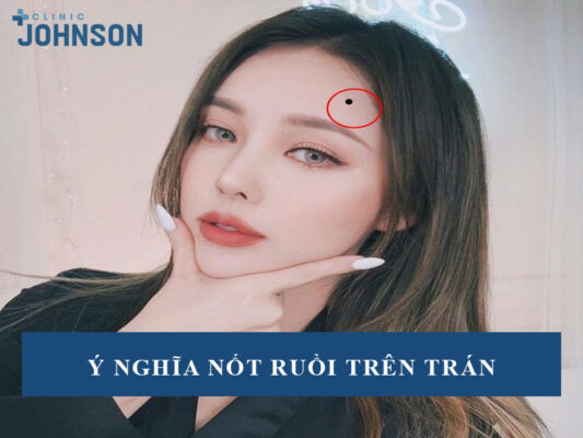 Nốt ruồi trên trán