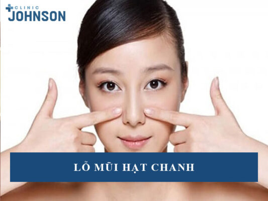 Lỗ mũi hạt chanh