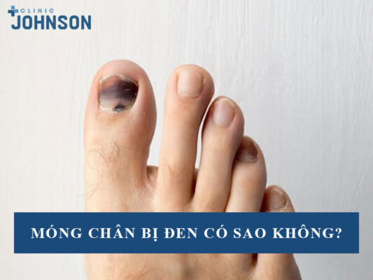 Móng chân bị đen