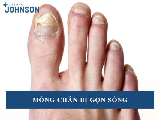 Móng chân bị gợn sóng