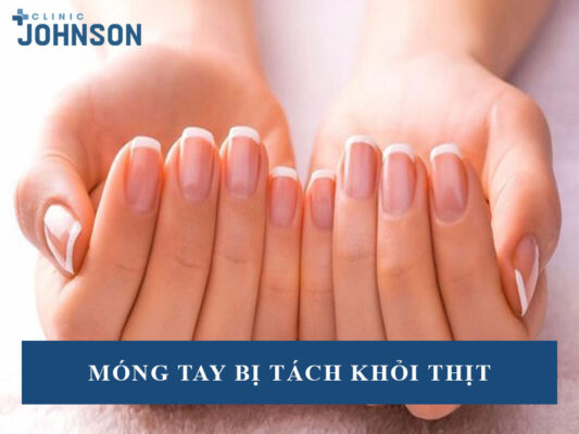 Móng tay bị tách khỏi thịt