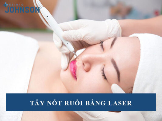 Tẩy nốt ruồi bằng laser