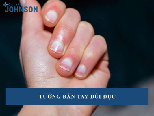 tướng bàn tay dùi đục