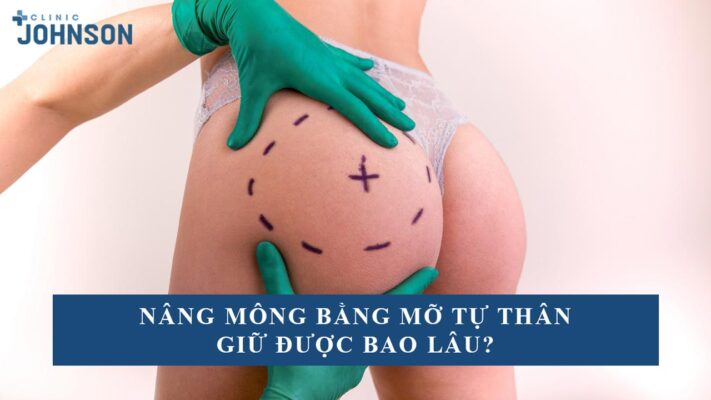 nâng mông bằng mỡ tự thân giữ được bao lâu